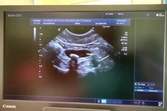 Vétérinaire Péronne Europe Echographie d’un calcul de vessie